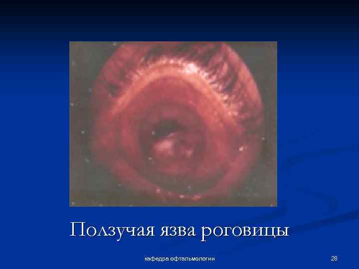 Ползучая язва роговицы кафедра офтальмологии 28 
