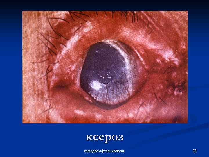 ксероз кафедра офтальмологии 29 