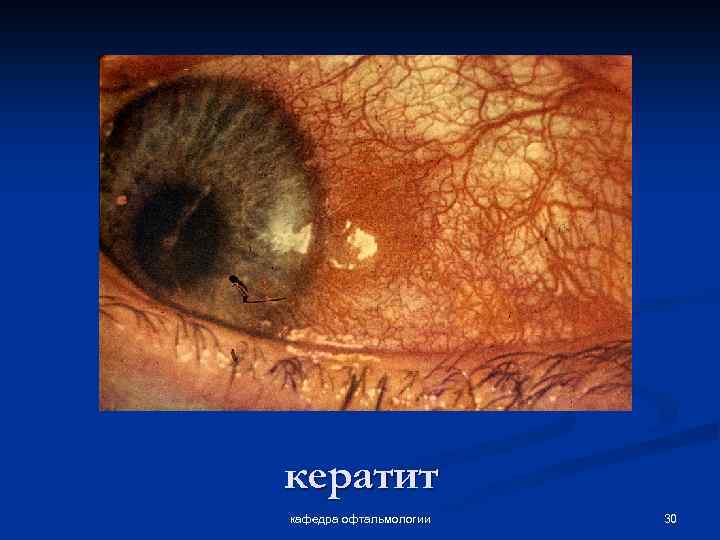 кератит кафедра офтальмологии 30 