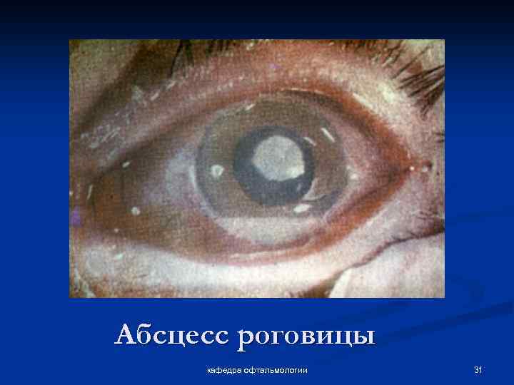 Абсцесс роговицы кафедра офтальмологии 31 