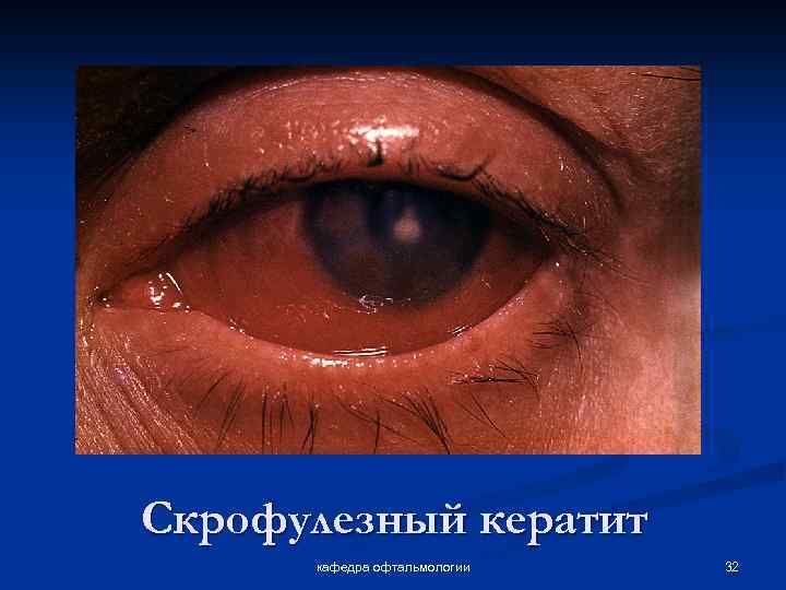 Скрофулезный кератит кафедра офтальмологии 32 