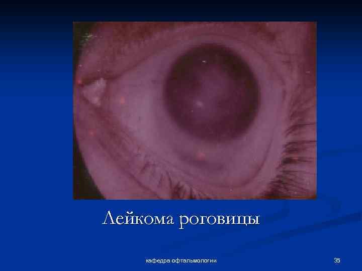 Лейкома роговицы кафедра офтальмологии 35 