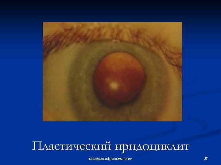 Пластический иридоциклит кафедра офтальмологии 37 