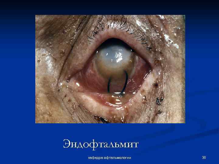 Эндофтальмит кафедра офтальмологии 38 