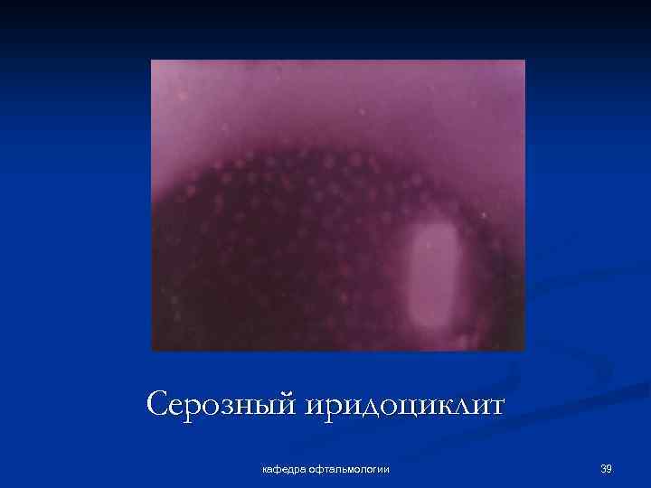 Серозный иридоциклит кафедра офтальмологии 39 
