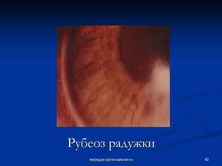 Рубеоз радужки кафедра офтальмологии 40 
