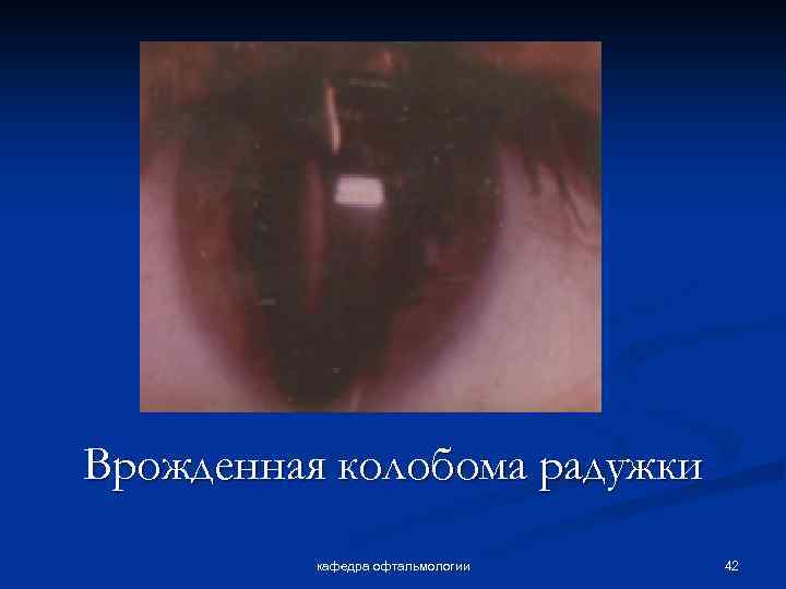 Врожденная колобома радужки кафедра офтальмологии 42 