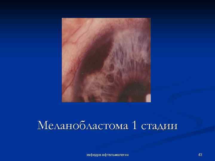 Меланобластома 1 стадии кафедра офтальмологии 43 