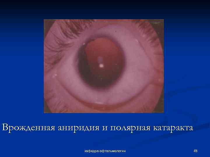 Врожденная аниридия и полярная катаракта кафедра офтальмологии 45 