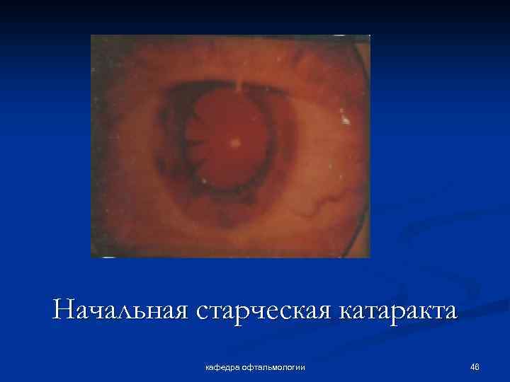 Начальная старческая катаракта кафедра офтальмологии 46 