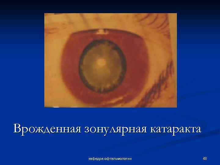 Врожденная зонулярная катаракта кафедра офтальмологии 48 