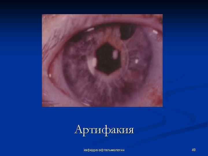 Артифакия кафедра офтальмологии 49 