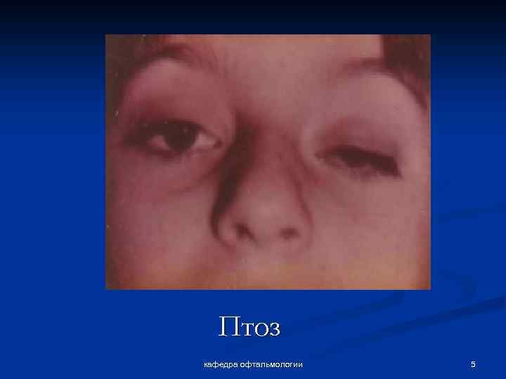 Птоз кафедра офтальмологии 5 