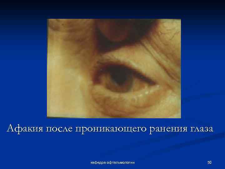 Афакия после проникающего ранения глаза кафедра офтальмологии 50 