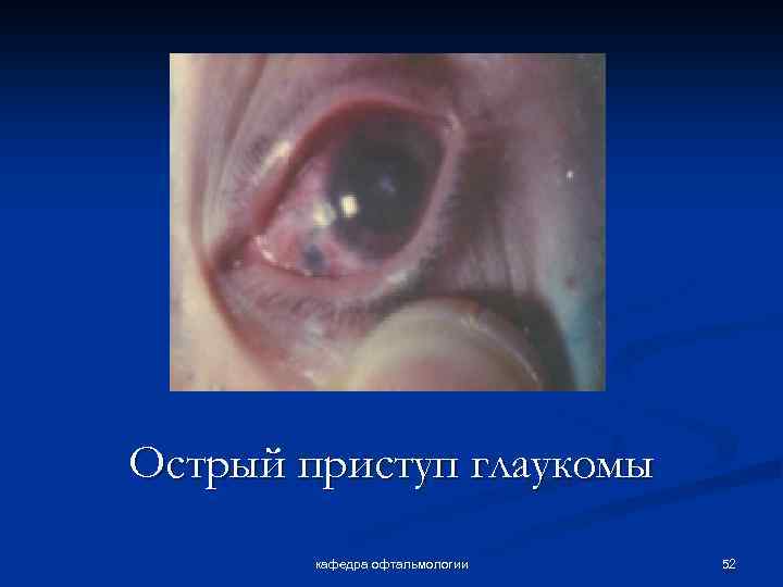 Острый приступ глаукомы кафедра офтальмологии 52 