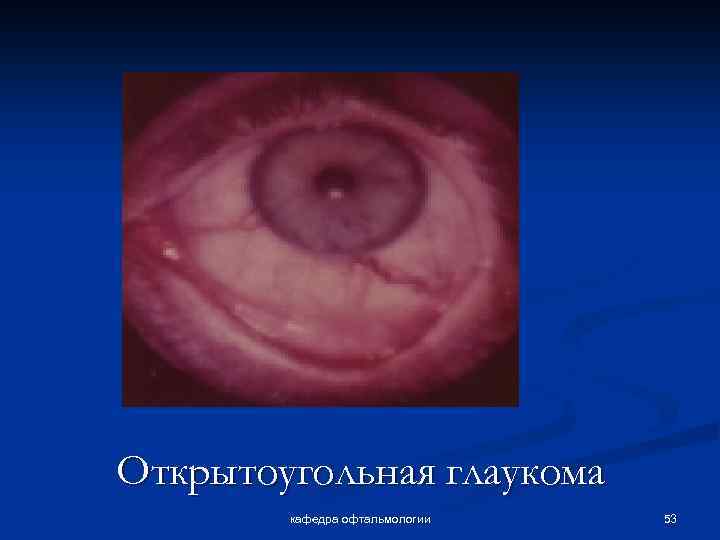 Открытоугольная глаукома кафедра офтальмологии 53 