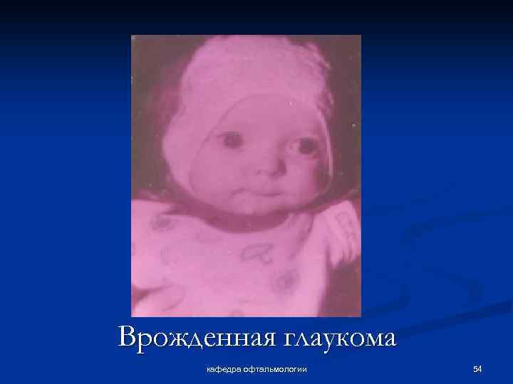Врожденная глаукома кафедра офтальмологии 54 