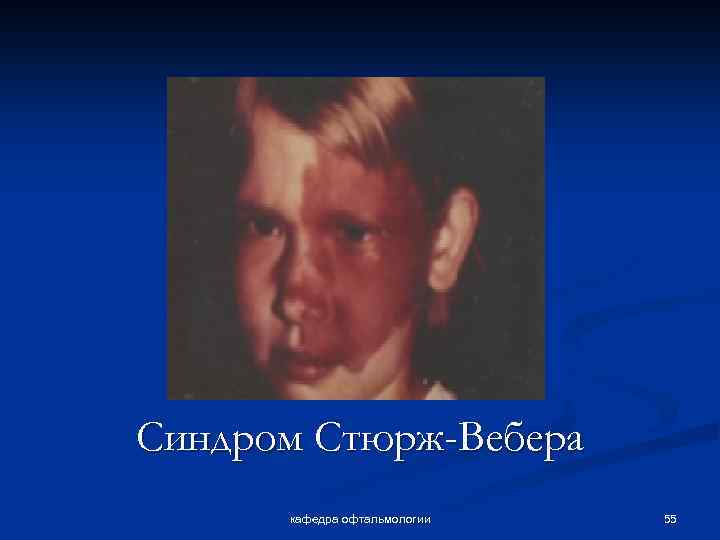 Синдром Стюрж-Вебера кафедра офтальмологии 55 