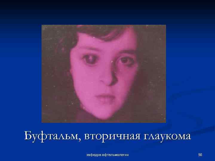 Буфтальм, вторичная глаукома кафедра офтальмологии 56 