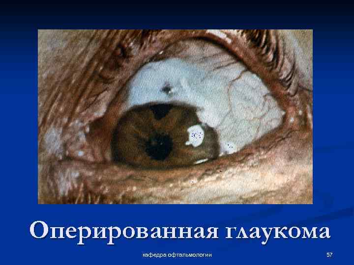 Оперированная глаукома кафедра офтальмологии 57 