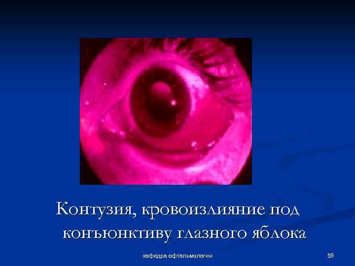 Контузия, кровоизлияние под конъюнктиву глазного яблока кафедра офтальмологии 59 