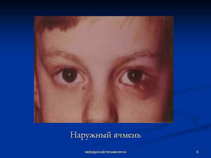 Наружный ячмень кафедра офтальмологии 6 
