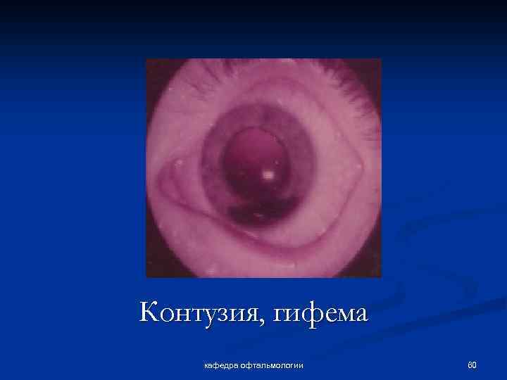 Контузия, гифема кафедра офтальмологии 60 