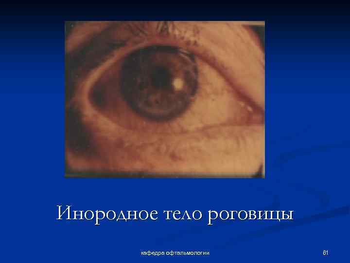 Инородное тело роговицы кафедра офтальмологии 61 