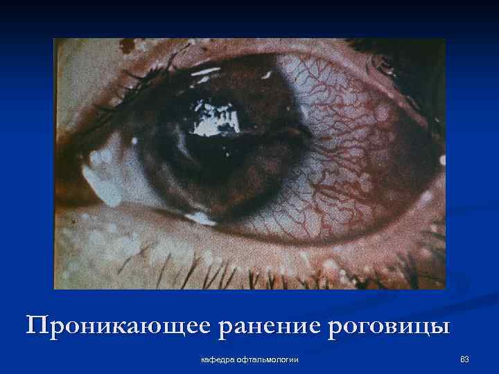 Проникающее ранение роговицы кафедра офтальмологии 63 