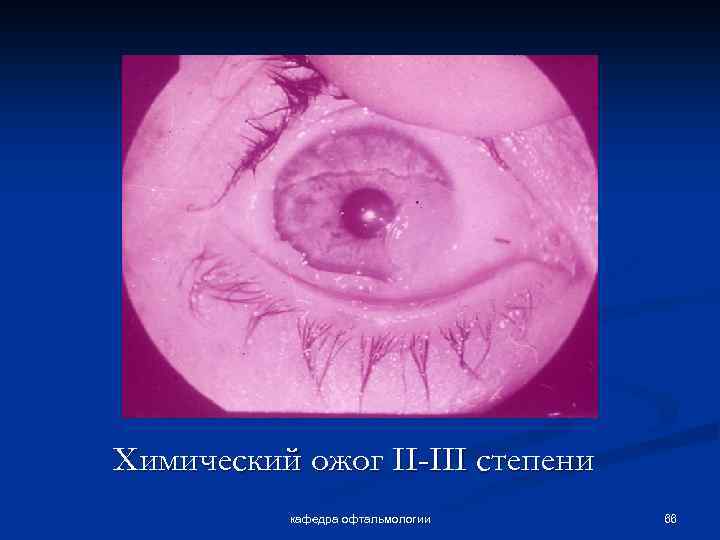 Химический ожог II-III степени кафедра офтальмологии 66 