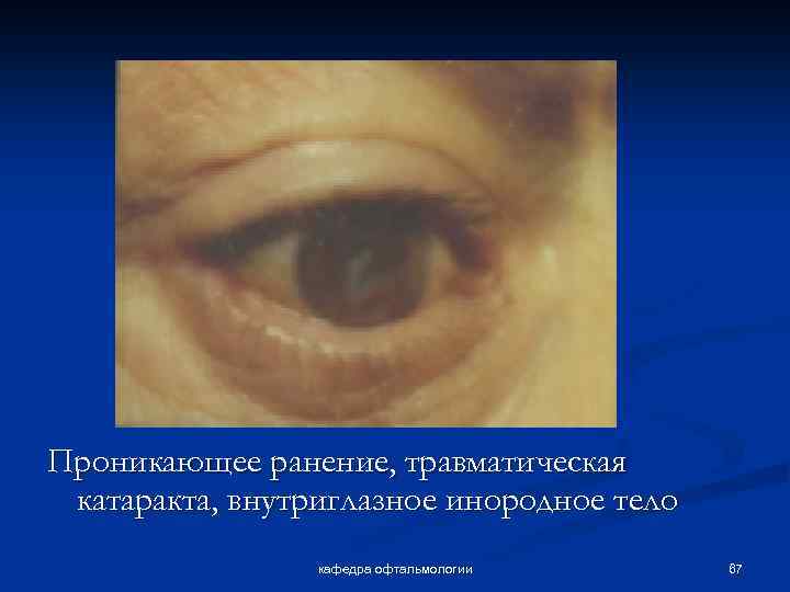 Проникающее ранение, травматическая катаракта, внутриглазное инородное тело кафедра офтальмологии 67 