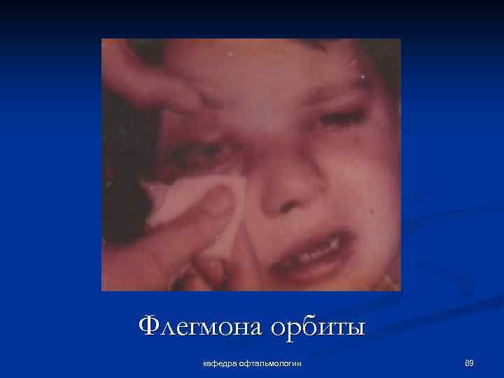 Флегмона орбиты кафедра офтальмологии 69 