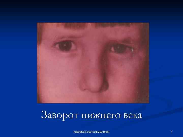 Заворот нижнего века кафедра офтальмологии 7 