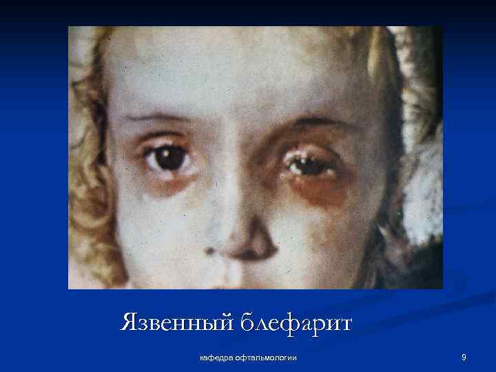 Язвенный блефарит кафедра офтальмологии 9 