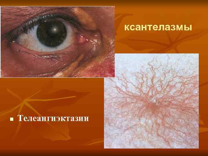      ксантелазмы n  Телеангиэктазии 