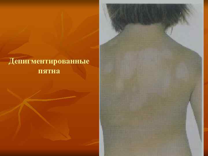 Депигментированные   пятна 