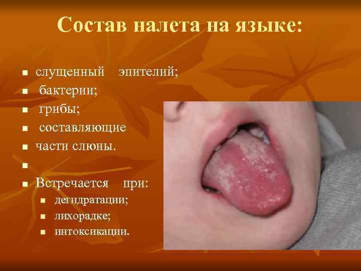   Состав налета на языке:  n  слущенный  эпителий;  n
