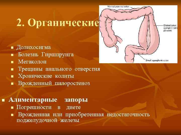   2. Органические  n  Долихосигма n  Болезнь Гиршпрунга n 