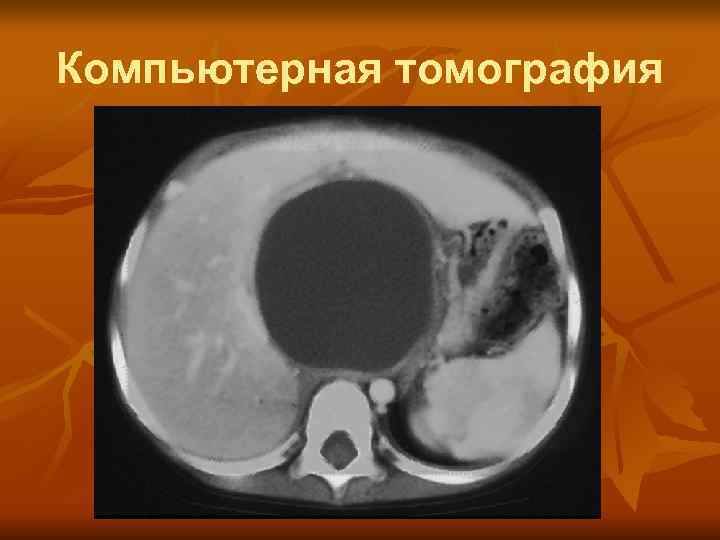 Компьютерная томография 