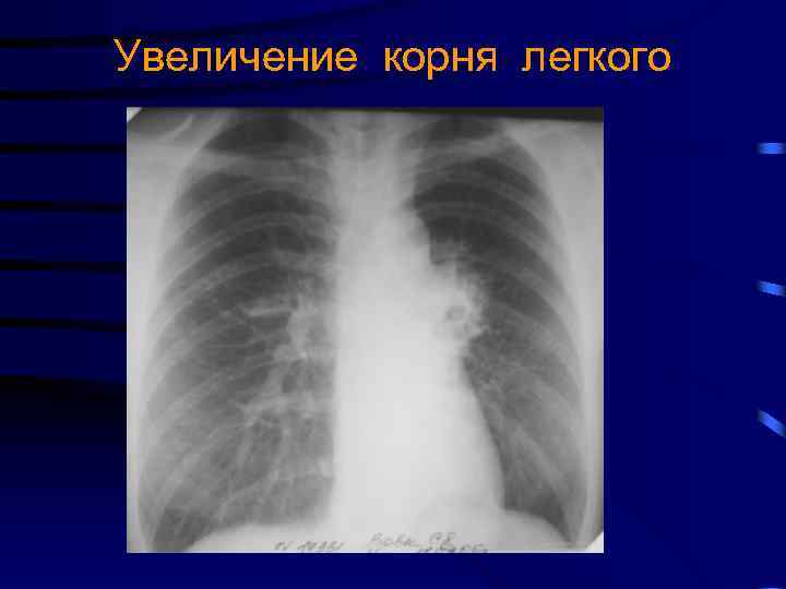 Увеличение корня легкого 