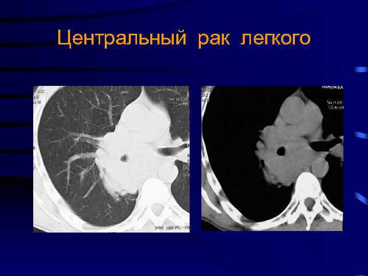 Центральный рак легкого 
