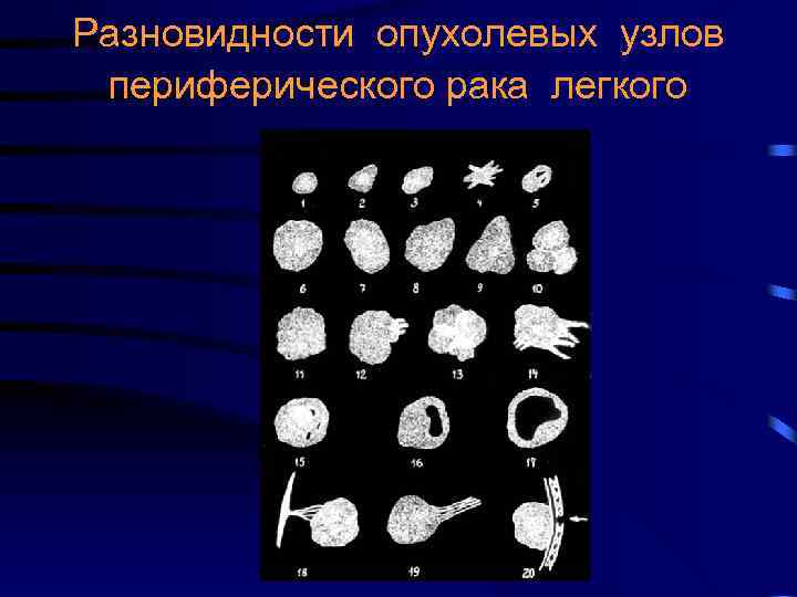 Разновидности опухолевых узлов периферического рака легкого 