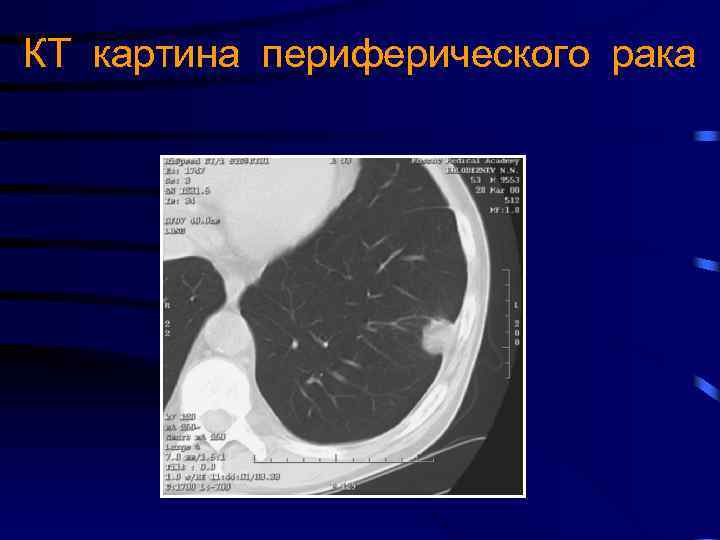 КТ картина периферического рака 