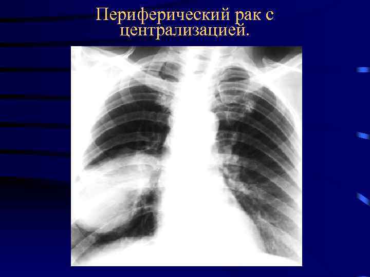 Периферический рак с централизацией. 