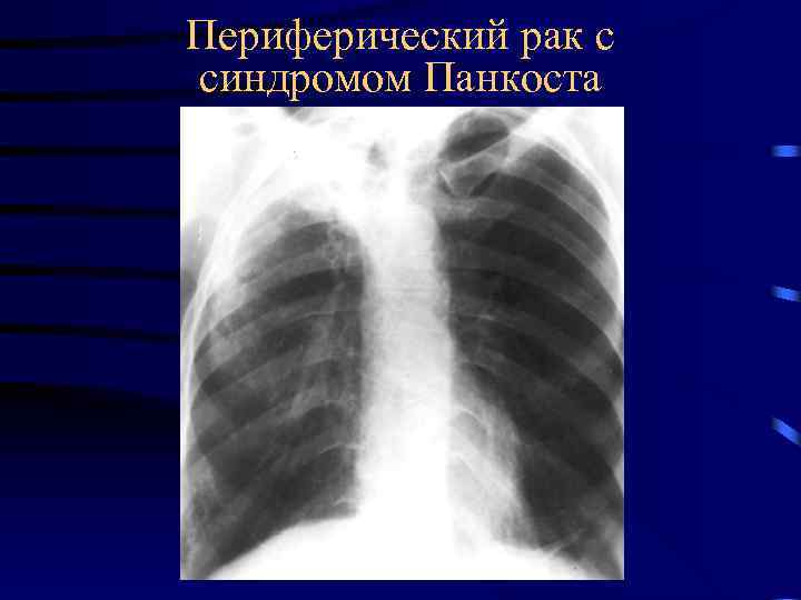 Периферический рак с синдромом Панкоста 