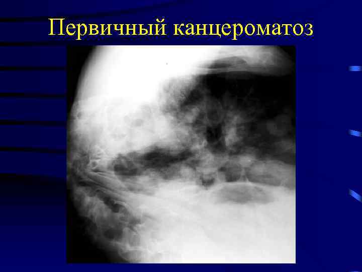Первичный канцероматоз 