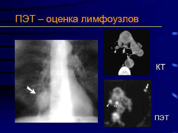 ПЭТ – оценка лимфоузлов КТ ПЭТ 