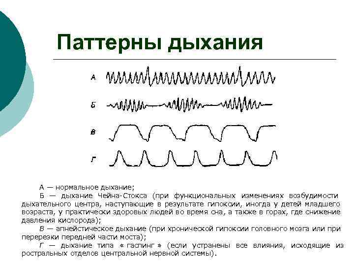   Паттерны дыхания   А — нормальное дыхание;  Б — дыхание