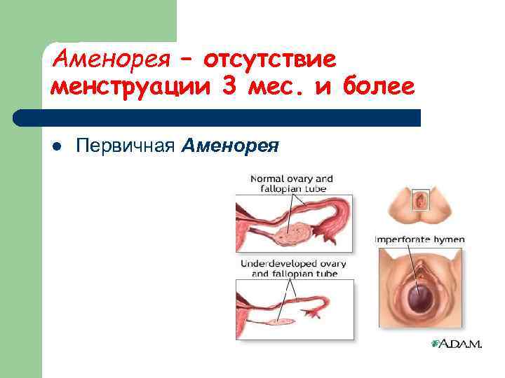 Аменорея – отсутствие менструации 3 мес. и более l  Первичная Аменорея 