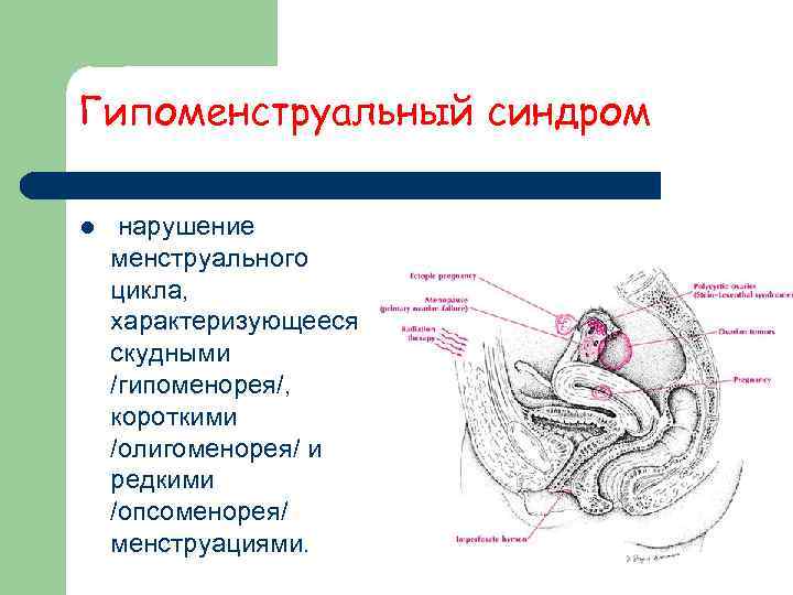 Гипоменструальный синдром l  нарушение менструального цикла,  характеризующееся скудными /гипоменорея/,  короткими /олигоменорея/